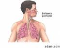 S’identifica un mecanisme responsable de l’emfisema pulmonar i la bronquitis crònica